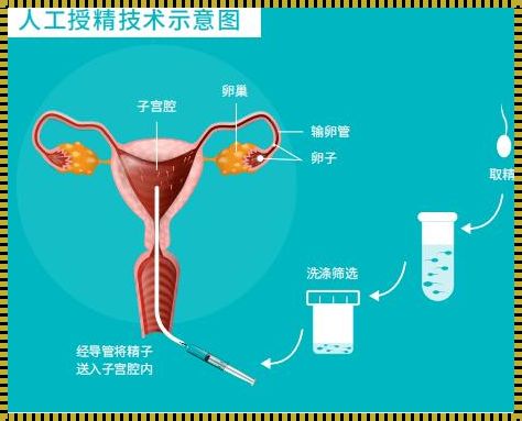 “精子大战：人工授精的XY战场”