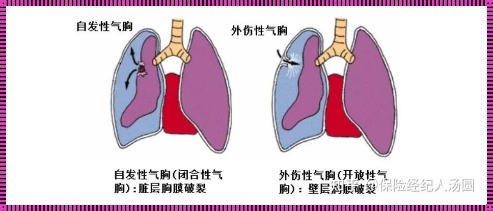 原发性气胸严重吗（探讨生命的气囊，揭秘肺部的小脾气）