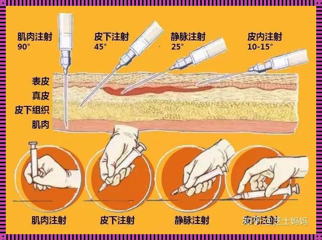 接种卡介苗的正确部位及方法是“皮上雕花，针下留情”