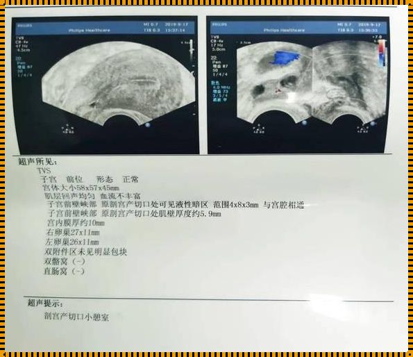 “子宫肥大”，哦，这小家伙的恶作剧！