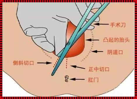 《侧切缝合，图的不是几层，是层层惊心！》