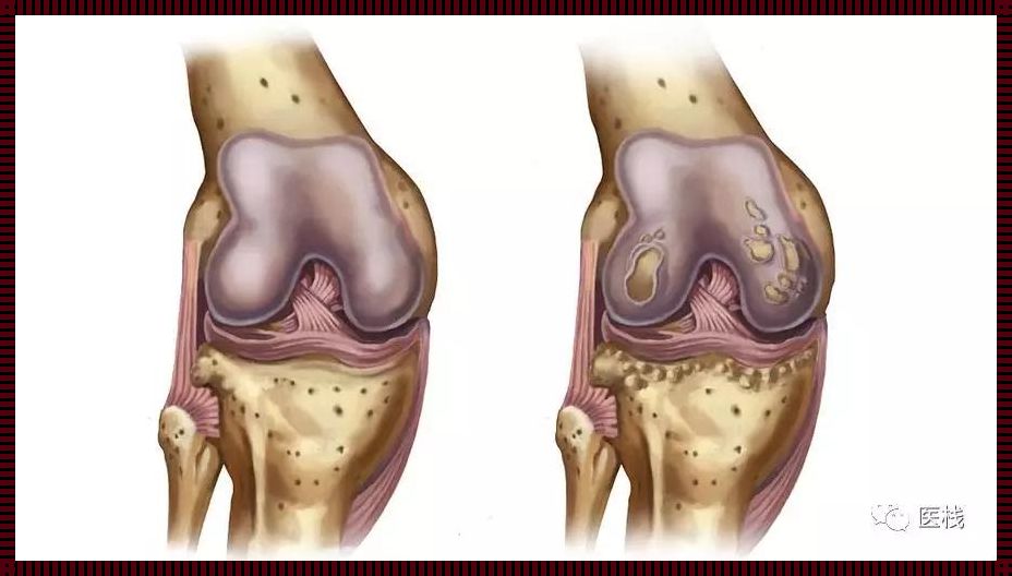 “痛不欲生”还是“增生不痛”？骨质增生疼痛大揭秘！