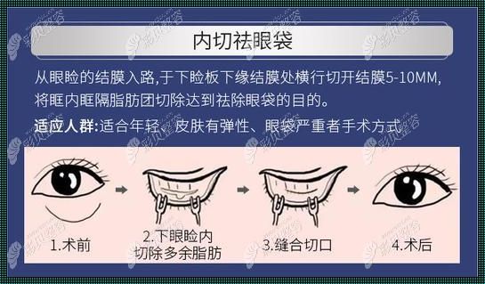 去眼袋，不手术也能“笑到最后”的邪门歪道