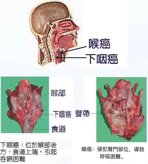 声门癌与喉癌：自嘲式探幽