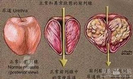 前列腺囊肿，竟是这个鸟样！