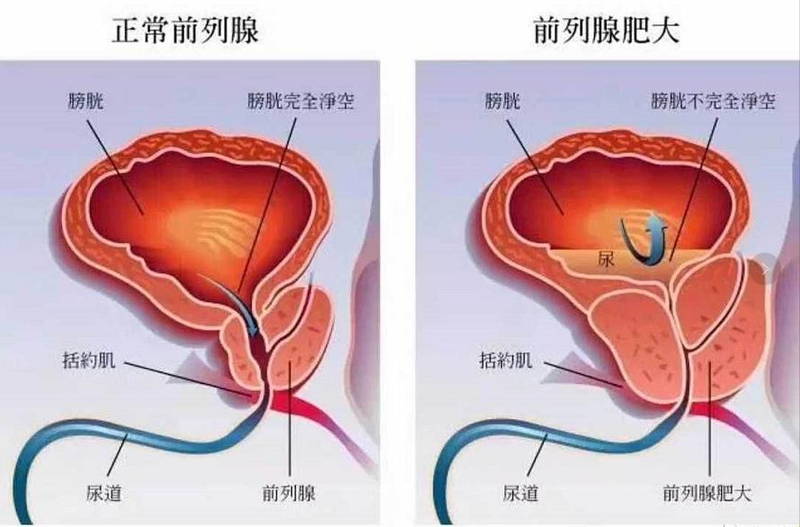 年轻人也会“挺”不起来的病？笑谈前列腺增生