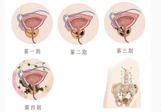 前列腺那些事儿：不均伴钙化，你懂的！