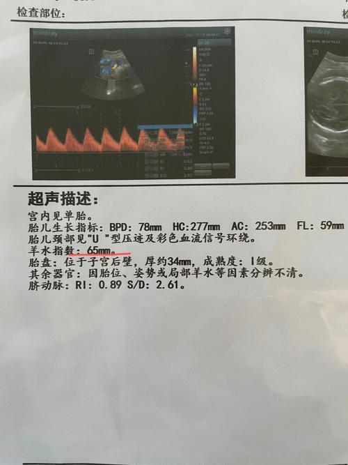 “羊水少，心不慌，智慧解‘水’荒”