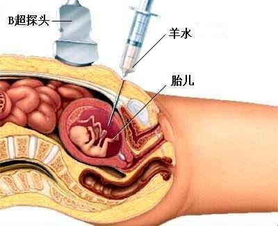 《羊水穿刺，揭秘孕期“针尖上的舞蹈”》