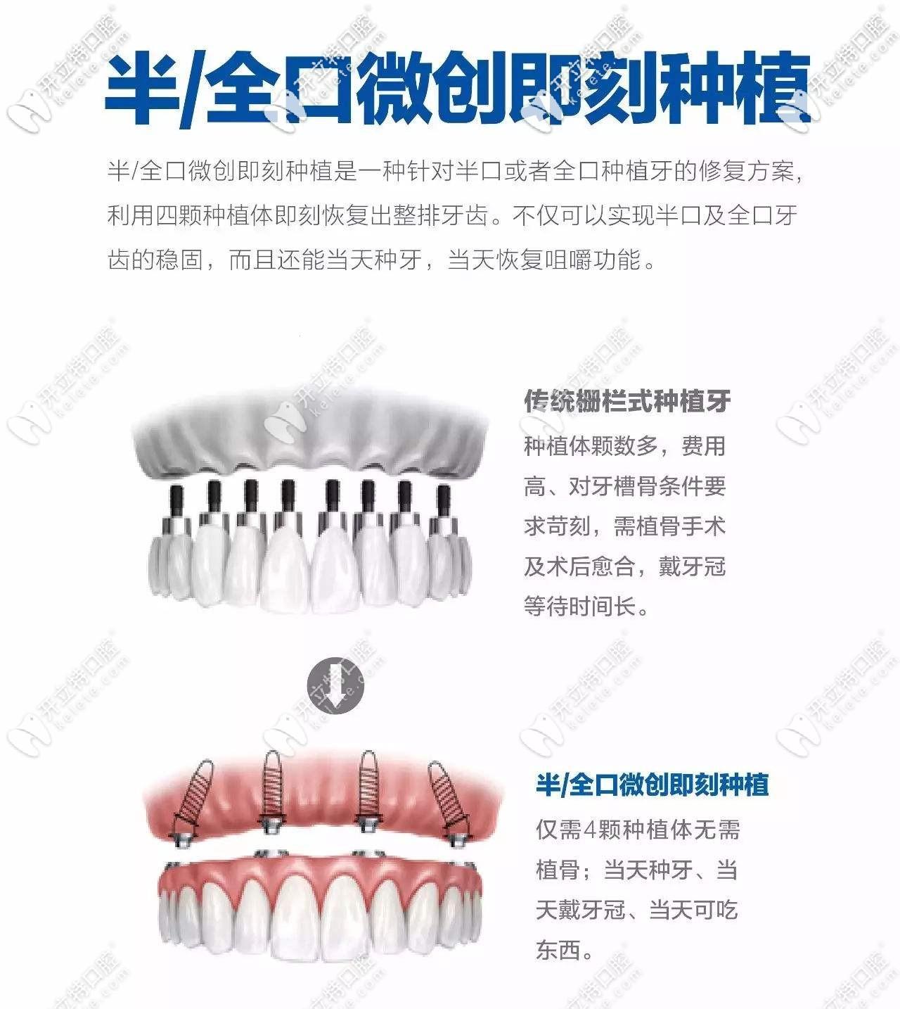 种植牙与镶牙，说穿了不过是一场“换牙游戏”