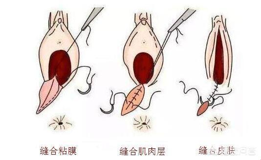 产道风华：不侧切，难道会松？