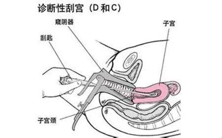 刮宫之旅：幽默与苦涩的搅拌机