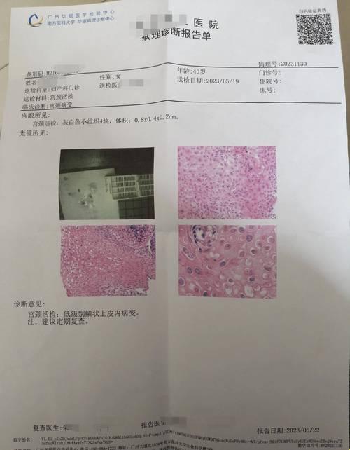 宫颈活检，一场心跳的游戏：结果是惊还是喜？