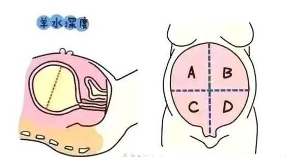 29周羊水少，胎儿的小秘密你猜猜？