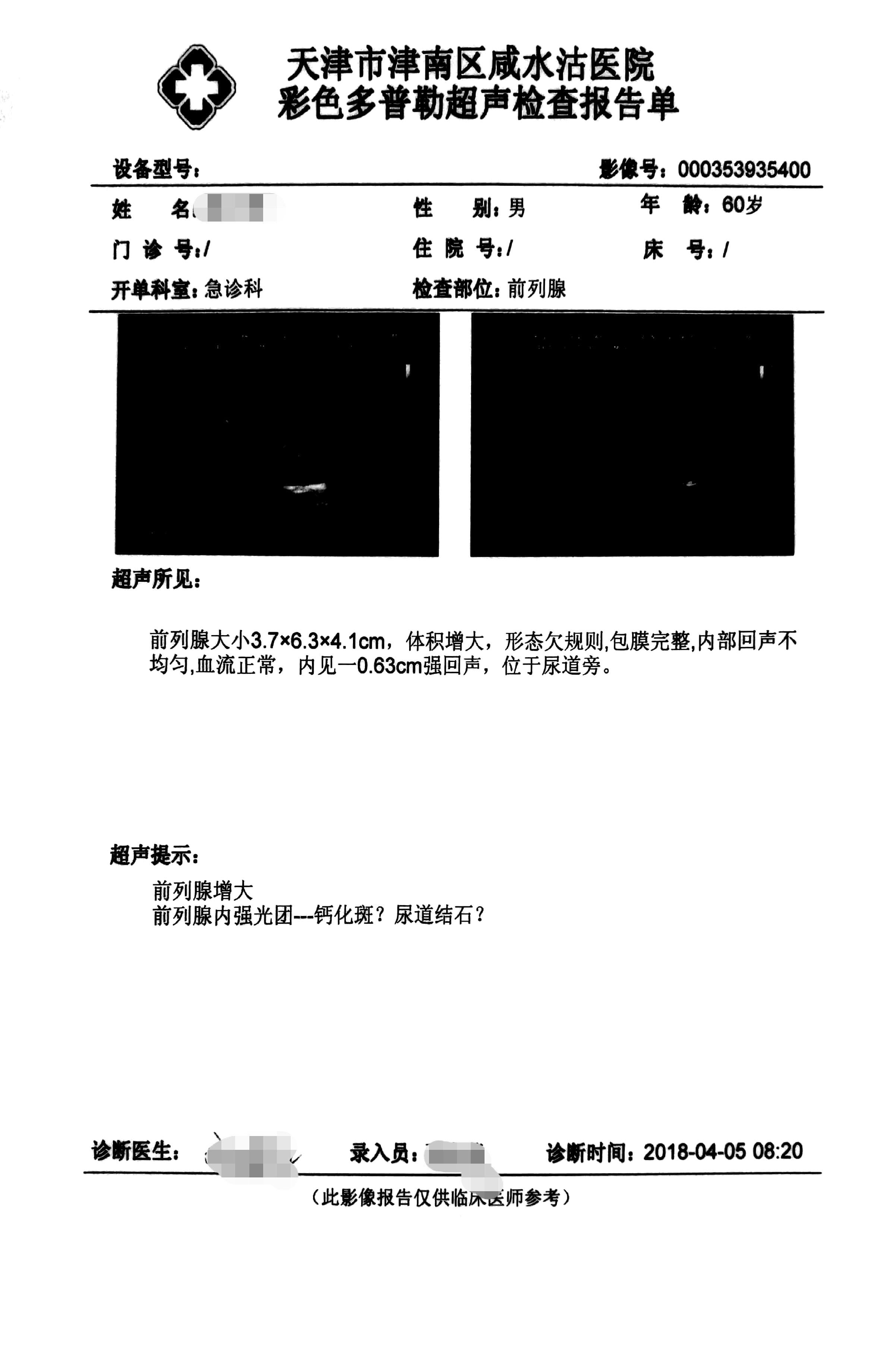 B超下的前列腺增生：别逗了，这是分度标准？