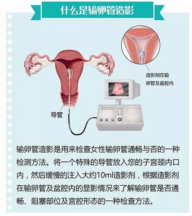 输卵管检查，痛不痛？笑谈中揭晓谜底