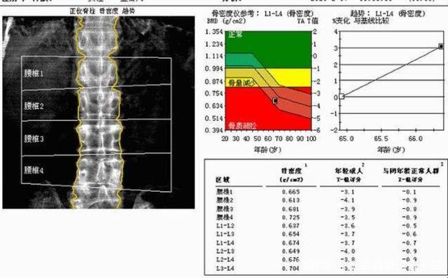 骨质密度，你的“硬”度咋这么难猜？