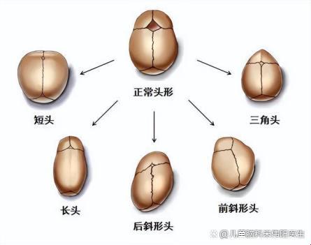 矢状缝早闭，几个月算提前毕业？