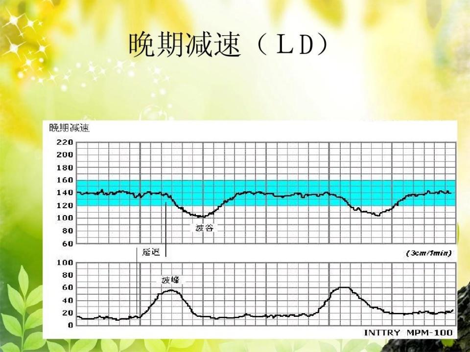 孕晚期胎心监护：幽默视角下的目的和意义