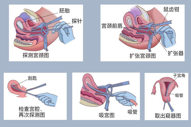 “小诊所里的人流‘艺术’: 一出滑稽剧场的幕后台前”