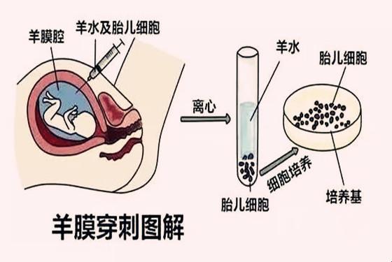 “羊水一把抓，孕检中的‘甜蜜’误会”