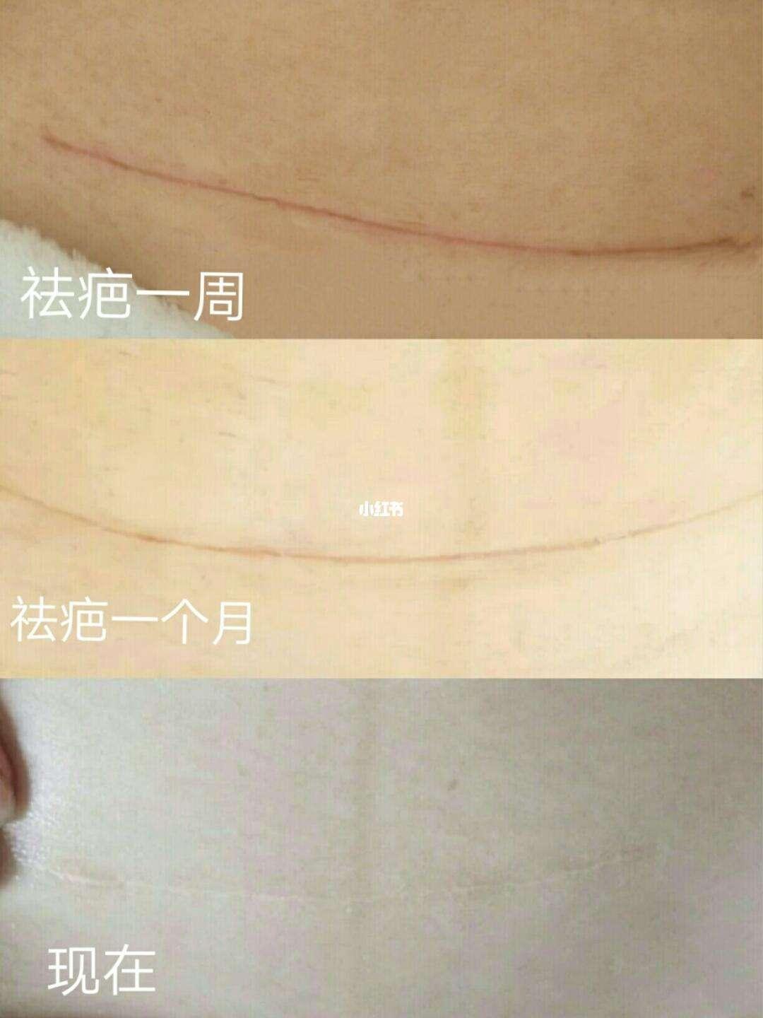 剖腹产疤痕打“疤痕针”？这笑话好冷！