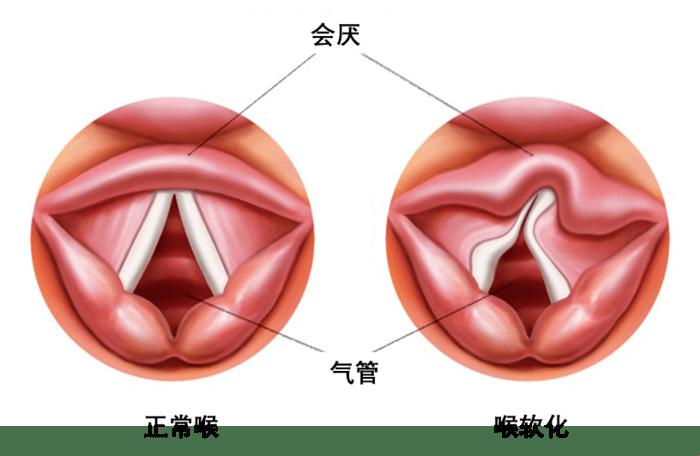 喉软骨宝贝，饭量缩水记