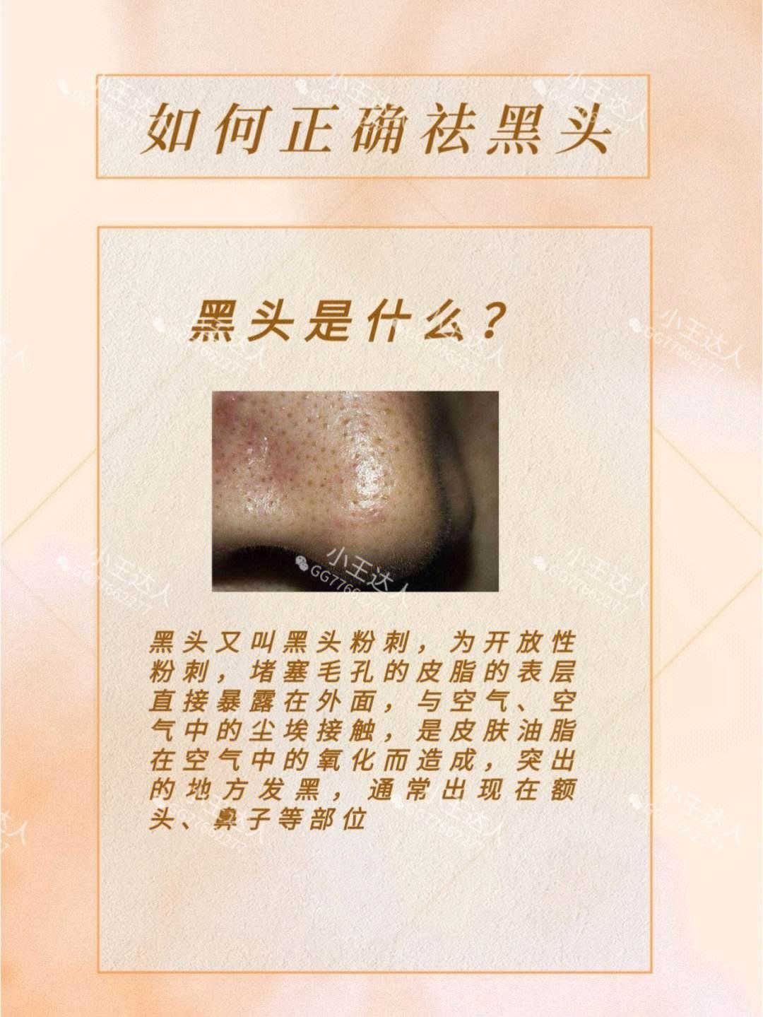 毛孔粗大，黑头捣乱？恭喜你，中奖啦！