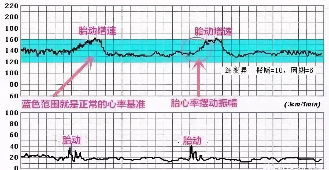 胎心基线低，揭秘“低速俱乐部”的奥秘