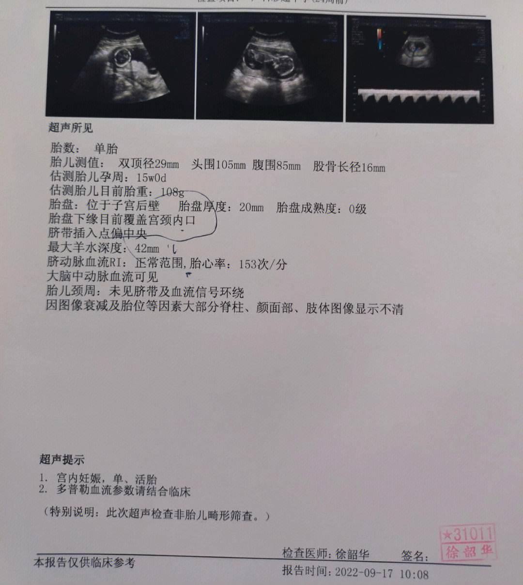 孕18周，胎盘下缘离宫颈口17mm，这是要闹哪样？