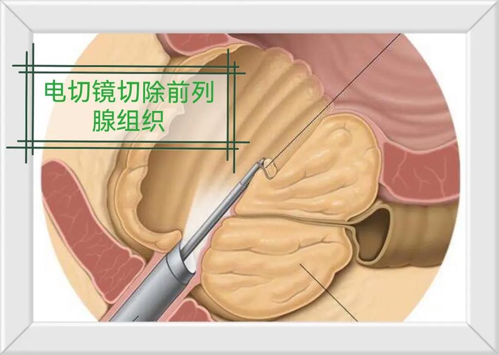 前列腺增生，根除有招！