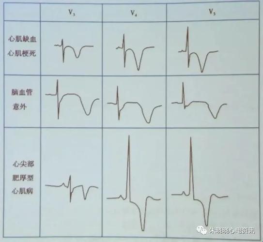 T波改变V3V4，轻松一窥究竟