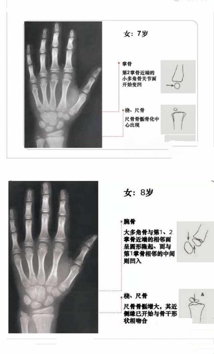 《中华05标骨女孩，嘻哈“骨龄舞”跳起来！》