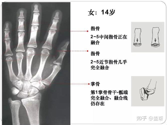 骨龄14，蹿个儿还差几厘米？笑谈！