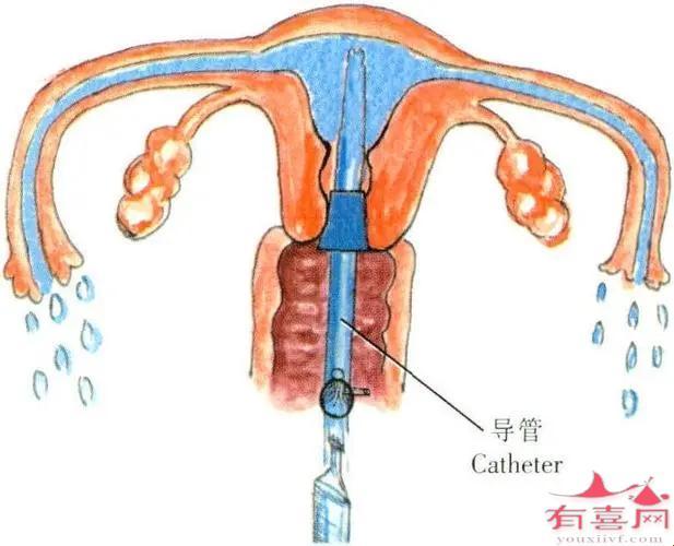 输卵管堵塞，宫腹腔镜手术的“梗”如何解？