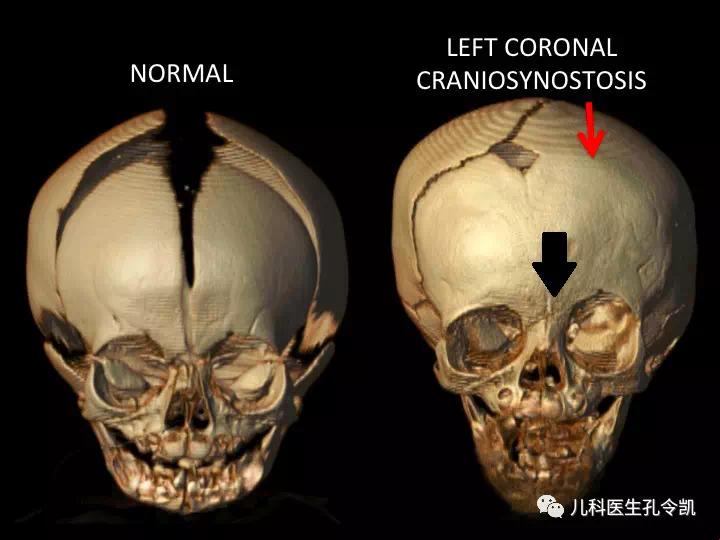 胎儿颞部凹陷，是掀起脑壳的风潮还是误入歧途的胎记？