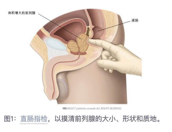 前列腺与直肠：一场不为人知的“亲密”关系大揭秘