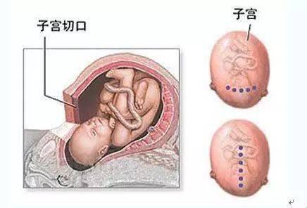 剖腹产：一刀下去，的后遗症有多少？