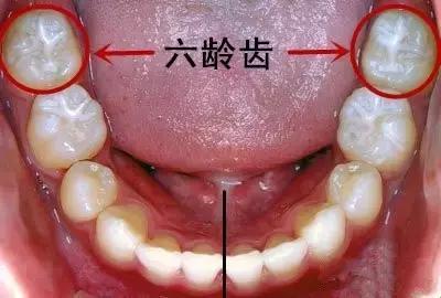 六龄牙，轻微龋，补否？笑谈中！