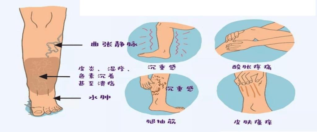 “静脉腿曲，笑谈间风采依旧：你不知道的趣事儿”