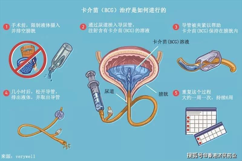 “卡介苗膀胱灌注”=化疗？这怕不是个“医疗奇谭”！