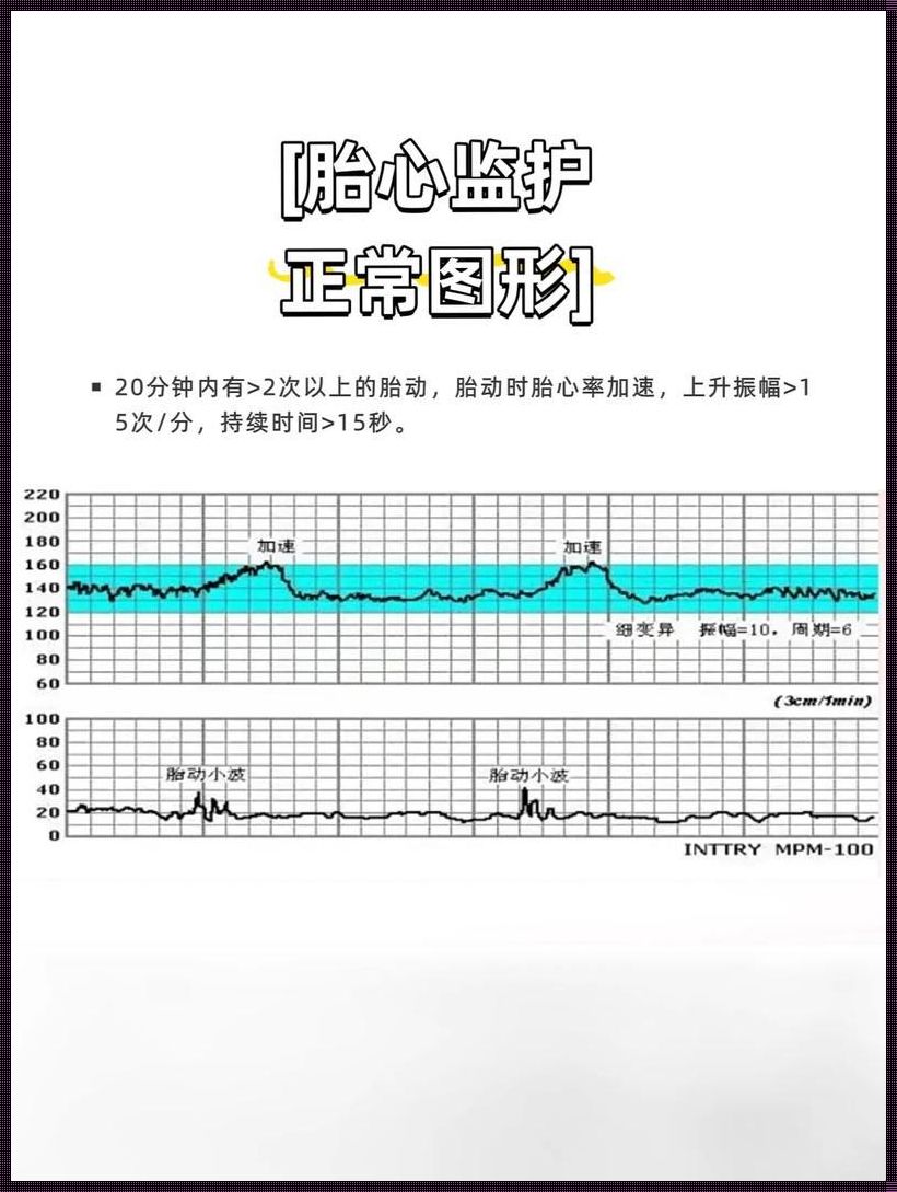 胎心监护图？荒诞解读来了！