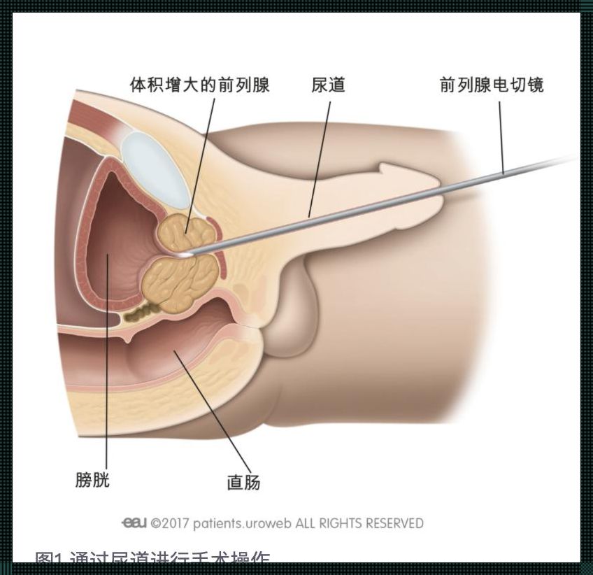 前列腺肿成巨无霸，手术刀伺候！