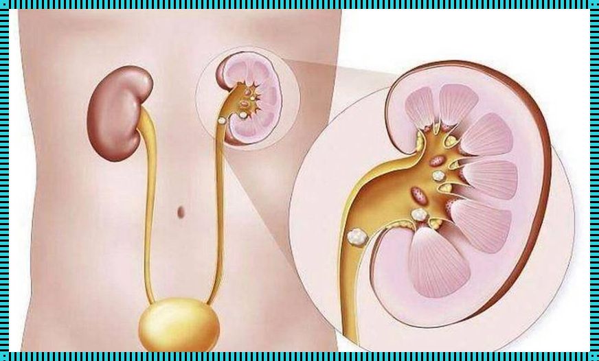 “输尿管结石，排出的不仅是石头，还是火山爆发的狂野气息！”