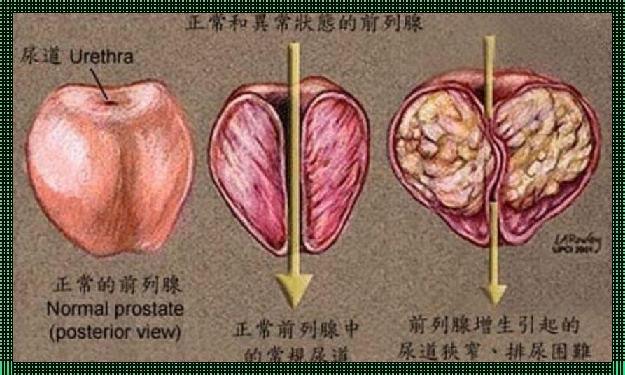 六旬大爷，前列腺之幽默自嘲