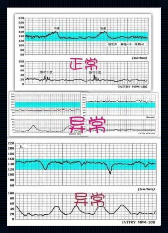 胎监下，宝宝“静如处子”就不过了吗？