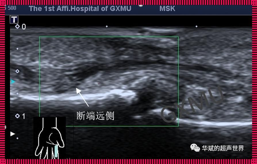 超声彩绘，肌腱断裂也难逃法眼？