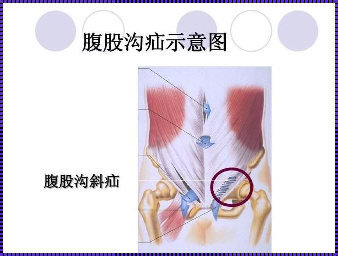 左斜疝，笑话一件：人体的尴尬艺术