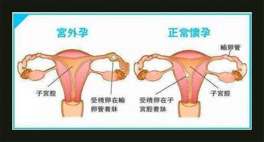 宫外孕 VS 打胎：哪个更“闹心”