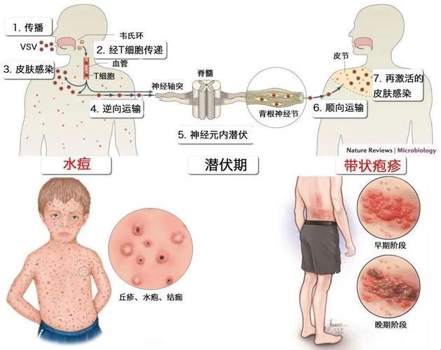 身上长病毒性疱疹？笑话！